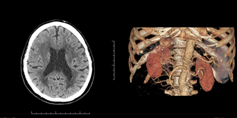 左から頭部、腎臓が写ったCT画像